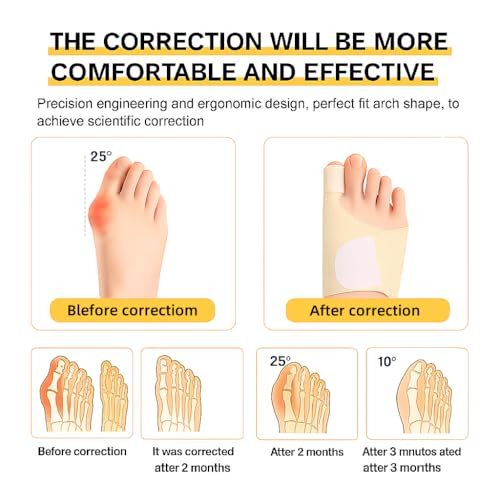 Bunion Corrector Support Brace: Pain Relief & Foot Alignment for Women & Men, 1 Pair for Day & Night Use