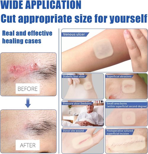 EASETEC 4"x4" Hydrocolloid Bandages 20 Packs, Thin Self-Adhesive Hydrocolloid Wound Dressing, Waterproof Patch for Bedsores, Ulcers & Surgical Incisions